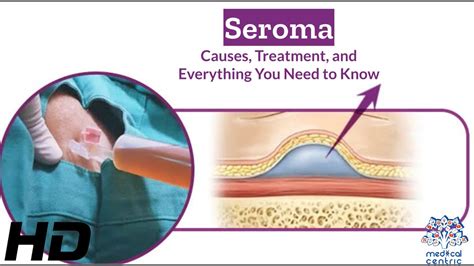 Seroma After Spay: A Common Surgical Complication